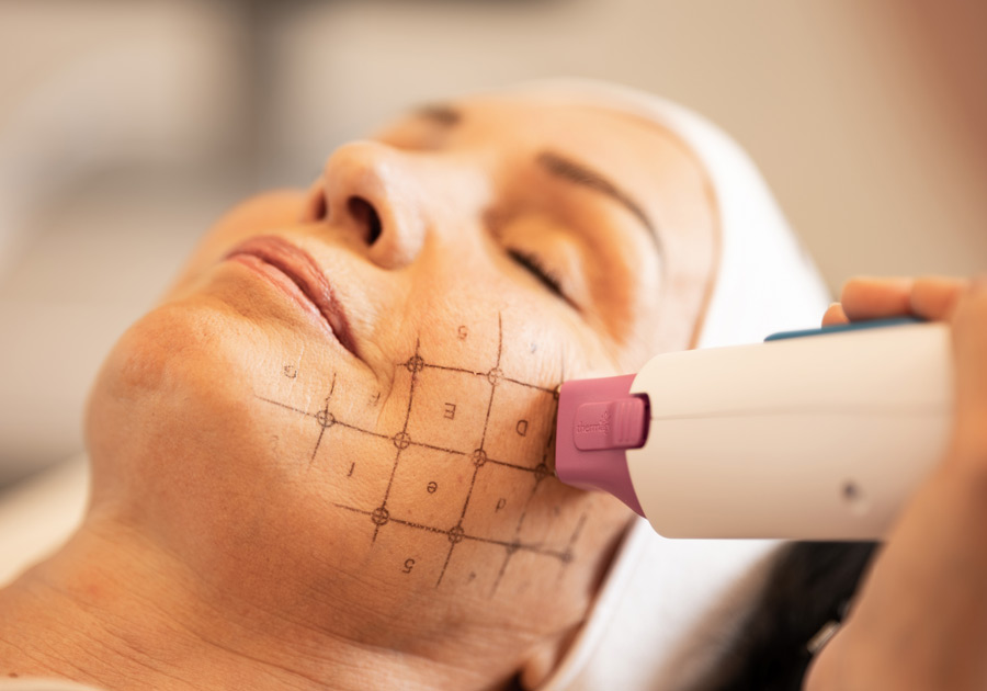 thermage_behandlung_praxis_dr_kalkan_deveci